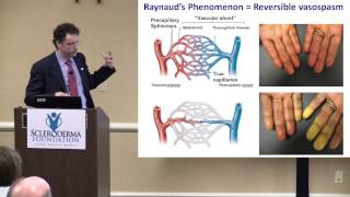 2015 Nashville The Scleroderma Hands and Their Care Dr Francesco Boin [upl. by Dnalyk]