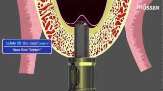 OSSTEM  HIOSSEN CASKit Crestal Approach Sinus Kit [upl. by Ayeki]