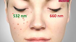 Freckles Pigmentation Treatment Singapore Ruvy Touch Pico Laser  Dr Justin Boey [upl. by Hanni347]