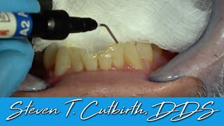 Bonding Incisal Edges of Anterior Teeth  Dental Minute with Dr Steven T Cutbirth DDS [upl. by Ammej]