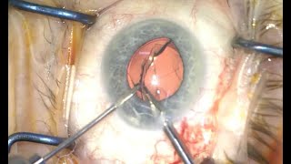 Multifocal removal and replacement with an Acufocus IC8 pinhole lens [upl. by Notniuqal]