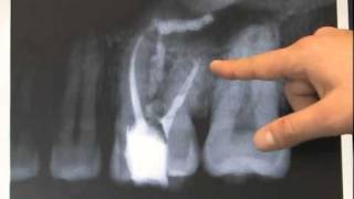 Endodontic Case  Found Calcium Hydroxide [upl. by Bakeman]