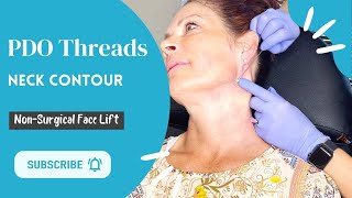 PDO Threads Neck Lift  Belladerm MedSpa [upl. by Atsocal113]