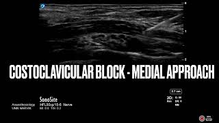 Costoclavicular block  medial approach  Regional anesthesia ultrasound regionalanesthesia [upl. by Sel35]