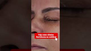 Como eu atuo em Xantelasma com Jato de plasma jatodeplasma xantelasma bellolharcursos [upl. by Mcmullan]