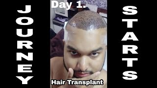 HAIR TRANSPLANT IN INDIA 2018  A MUST WATCH VIDEO FOR ALL  Journey has begunHINDI [upl. by Ecirtnahs548]