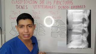 FRACTURAS VERTEBRALES DORSOLUMBARES clasificacion de DENIS TERCERA PARTE [upl. by Adnilema]