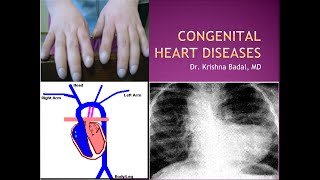 Congenital heart diseases [upl. by Tobe]