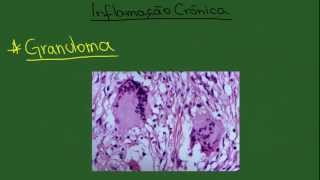 Inflamação Crônica  Resumo  Patologia Geral [upl. by Panta]