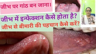 जीभ पर गांठ बन जानाHow to cure tongue related problemNormal structure of tongue tongue bump normal [upl. by Siul]