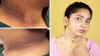 This is how you can easily get rid of dark neck fast easy and pernanently [upl. by Luhar518]