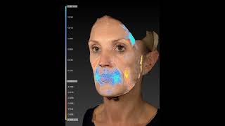 Dr Ana Mansouri Polynucleotide case study  smoothening amp repositioning of tissue with Canfield H2 [upl. by Suixela232]