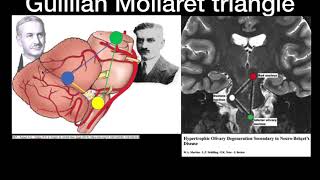 Hypertrophic Olivary degeneration [upl. by Orson335]