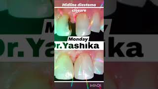 Midline diastema closure with composite restoration 🦷 📞 7419001200 [upl. by Michaele982]