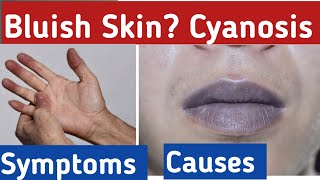 What is Cyanosis bluish skin cyanosis symptoms what is the cause of cyanosis [upl. by Siloam464]