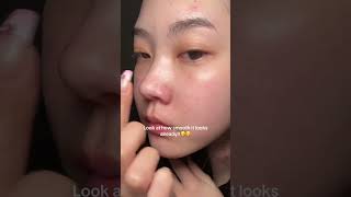 You wont catch congested pores ever anua global Anua Store US [upl. by Kcyrred60]