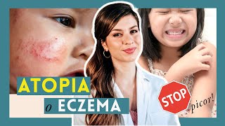 ✦ Piel ATÓPICA o eccema en BEBÉS y NIÑOS Cuidados y tratamiento del brote de dermatitis atópica [upl. by Lrac]