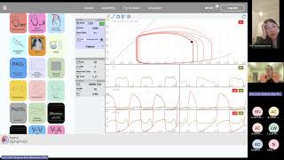 Mitral valve stenosis [upl. by Ynnal]