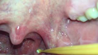 Tonsil Stone Extraction [upl. by Olrac456]