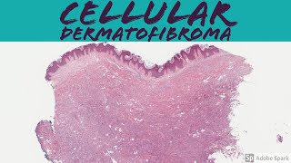 Cellular Dermatofibroma Cellular Fibrous Histiocytoma 5Minute Pathology Pearls [upl. by Golding]