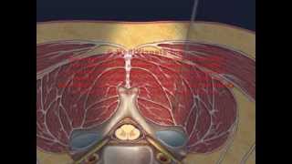 Cervical Interlaminar Epidural Injection Animation [upl. by Montague]