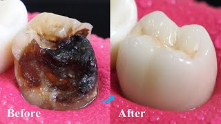 Incredible Restoration Of Tooth By Root Canal And Zirconia Crown [upl. by Andrien]