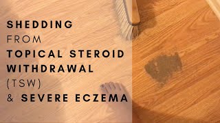 Healing Topical Steroid Withdrawal TSW amp Severe Eczema  The Nat Nurse [upl. by Jdavie]