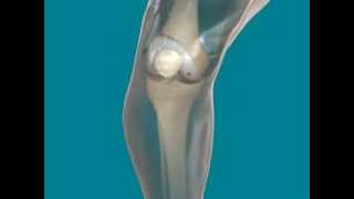 Lesión condral rodillaChondral lesion Knee [upl. by Katti853]