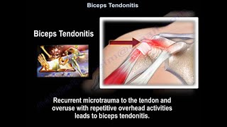 Biceps Tendonitis  Everything You Need To Know  Dr Nabil Ebraheim [upl. by Yankee]