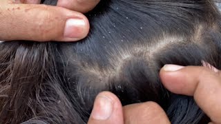 liceremoval checking lice and nits🥵and hunting lots ofnits 💯 asmr lice check roleplay 23 5 🇮🇳 [upl. by Nesnar]