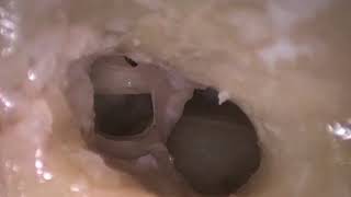 Posterior Tympanotomy with endoscopic checking [upl. by Seyer972]