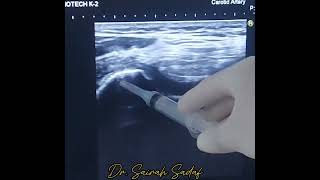 intraarticular Knee injection for OA knee joint by Dr Sairah Sadaf [upl. by Yendroc]