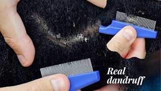 ASMR Real DANDRUFF 🤯  Super Zoomed  Scratching Parting Triggers For Sleep [upl. by Anyak]