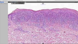 Lichenoid keratosis Phillip H McKee Antonina Kalmykova amp CSD Health Care [upl. by Einnoc]