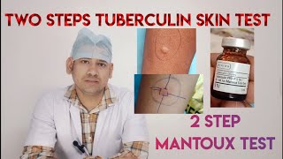 two step TUBERCULIN skin testtwo steps mantoux test mantoux test PPD SENSTIVITY TEST [upl. by Mccartan589]