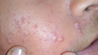 sac be spa blackheads elderly 2024  sac be spa old age blackheads 2024  sac be spa thuy 944 [upl. by Nylcsoj]