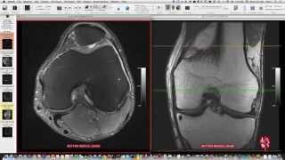 Systematic Interpretation of Knee MRI How I do it [upl. by Aitahs]