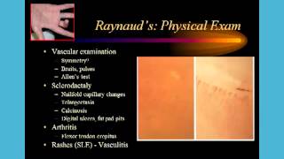 Dr Robert Valente Cold fingers and Raynauds Phenomenon [upl. by Aneehta]