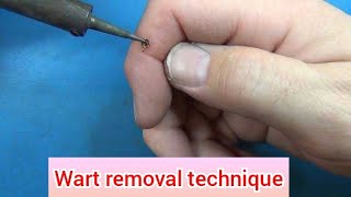 WART REMOVAL ELECTROCAUTERY [upl. by Faletti]