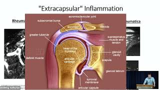 Polymyalgia Rheumatica What has changed since 1957 [upl. by Muirhead948]