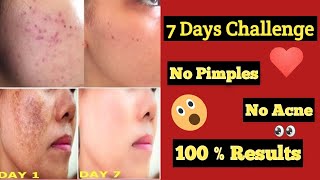 Acne Treatment  All You Need to Know About Acne amp Pimples  Best Home Remedies For Acne amp Pimples [upl. by Hartwell13]