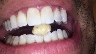 Most dangerous Tonsil stone removal [upl. by Shari133]