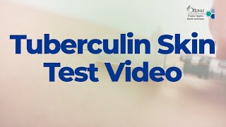 Tuberculin Skin Test Video  2022 [upl. by Otreblanauj]