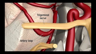 Treatment for Trigeminal Neuralgia UCSF Neurosurgery [upl. by Dibbrun707]