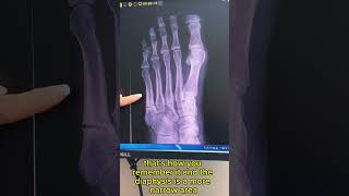 Jones Fracture  Diagnosis and Treatment [upl. by Alys138]