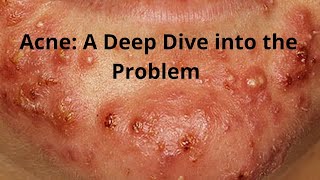 Acne A Deep Dive into the Problem [upl. by Acessej]