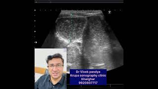 Intestinal obstruction by intestinal warms medico ultrasoundsbo abdominal pain abdomen pain [upl. by Ingeberg]