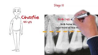 The new periodontal classification MUST WATCH FOR ALL DENTISTS [upl. by Mascia]