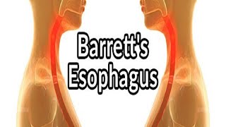 Barrett’s Esophagus What Is It and What Can Be Done to Reverse It [upl. by Eelyak]