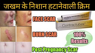 Contractubex Gel review पुराने से पुराने scars Marks को जड़ से मिटा देता है ये जेल।। [upl. by Barde]